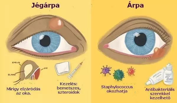 jégárpa és szemárpa összehasonlítása