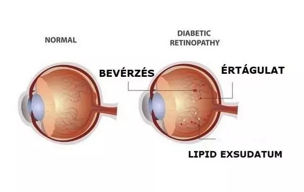diabéteszes retinopátia diabéteszes retinopátia