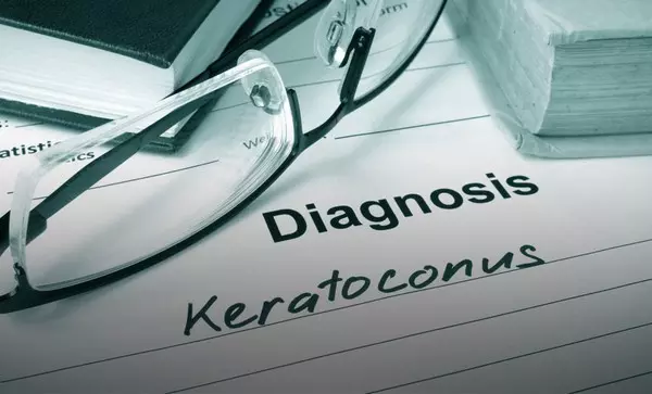 Diagnózis - keratokónusz Diagnózis - keratokónusz