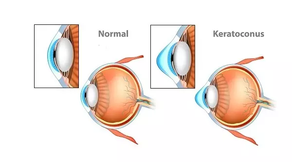 Keratoconus -  (ejtsd: keratokónusz)