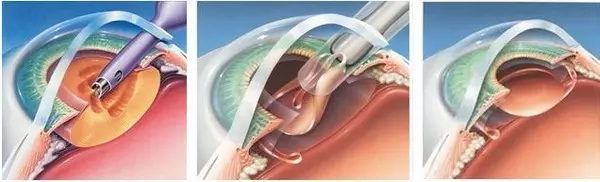 cataract cukorbetegség kezelésére