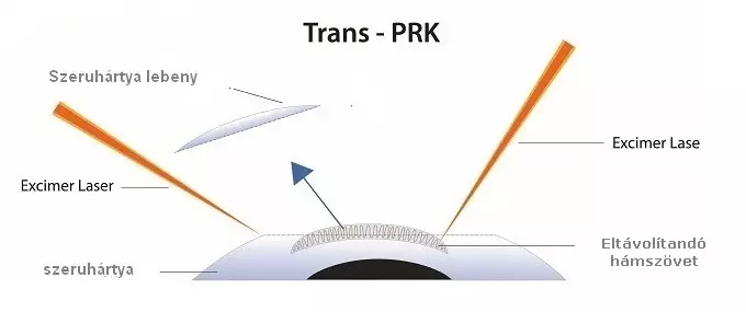 Trans PRK menete